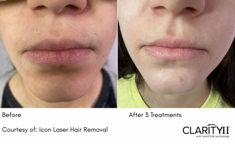 zenbar laser hair removal results