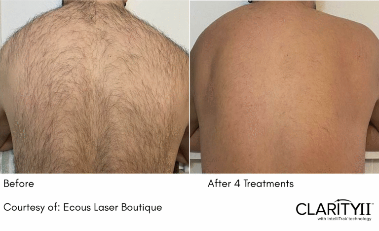 zenbar laser hair removal results