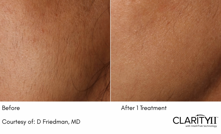 zenbar laser hair removal results