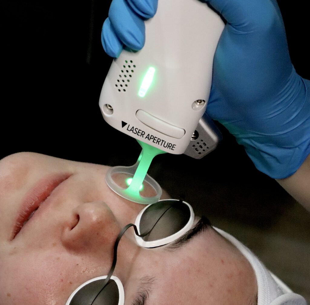 zenbar laser facial