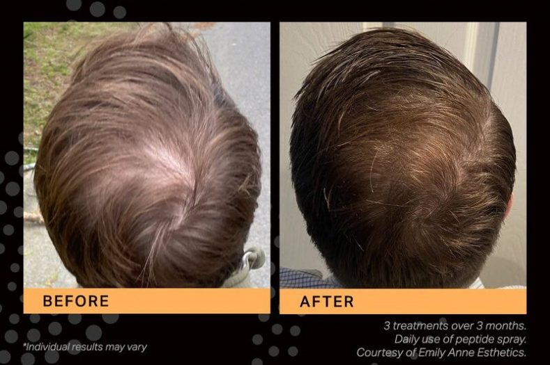 zenbar keravive results men