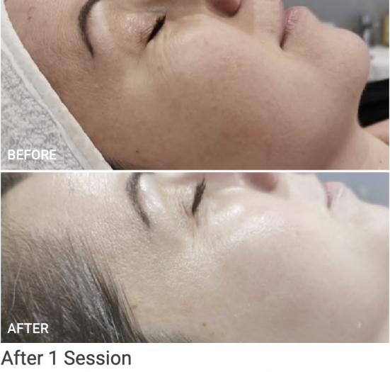 zenbar bloomea results skin rejuvenation