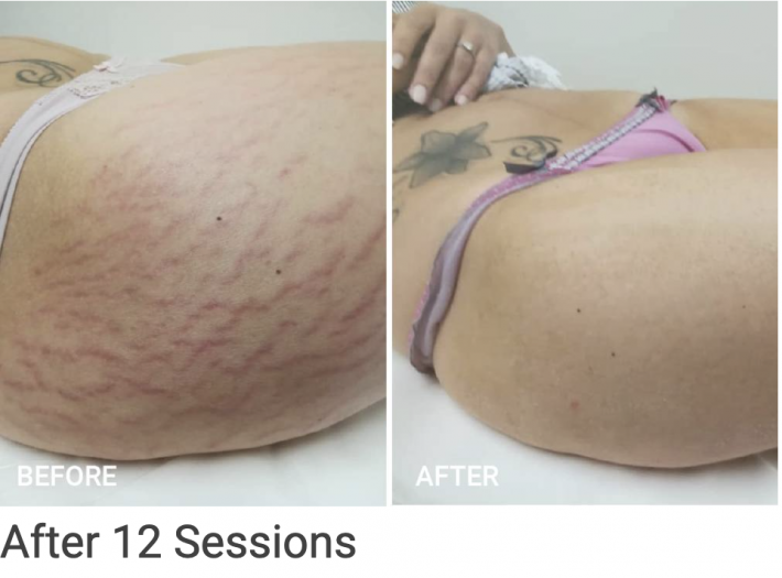 zenbar bloomea results stretch marks