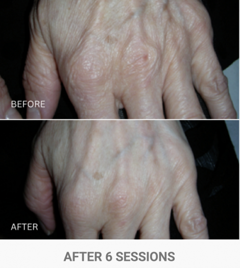 zenbar bloomea results skin rejuvenation hands