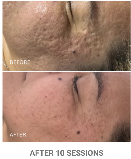 zenbar bloomea results skin rejuvenation
