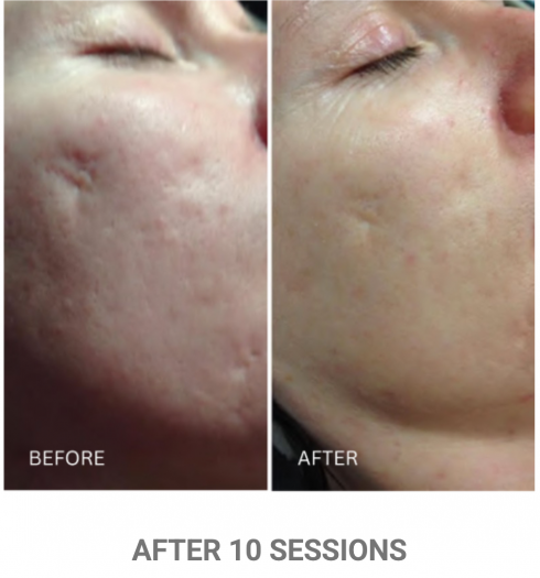 zenbar bloomea results skin rejuvenation