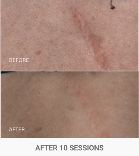 zenbar bloomea results scar